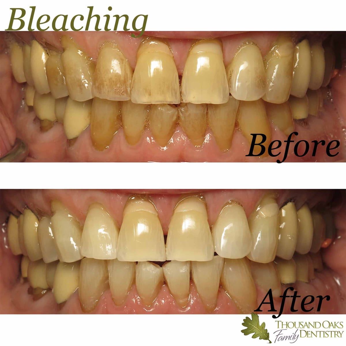 Before and after of professional teeth whitening showing deeply stained teeth visibly brightened