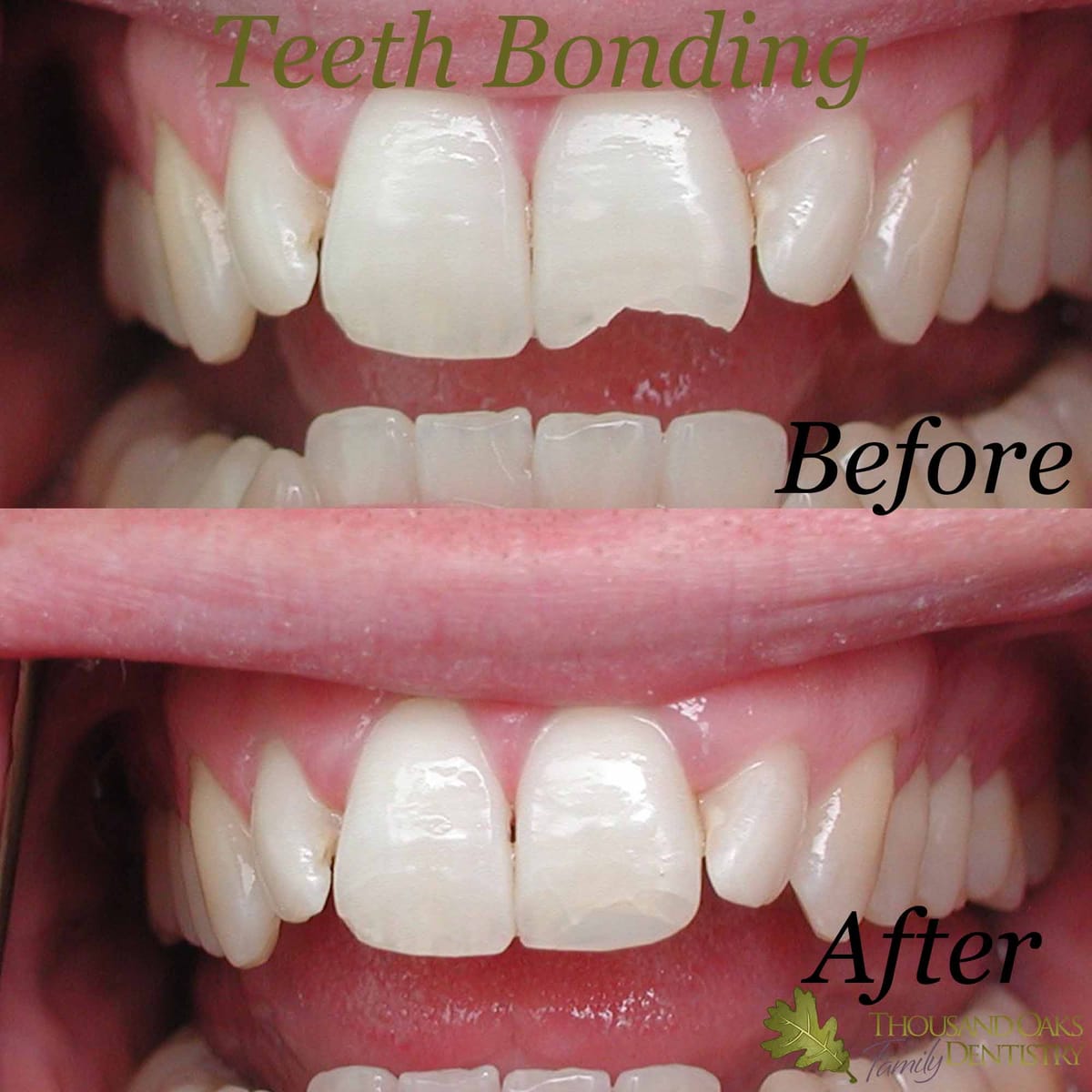 Before and after of a chipped front tooth repaired with tooth-colored cosmetic bonding