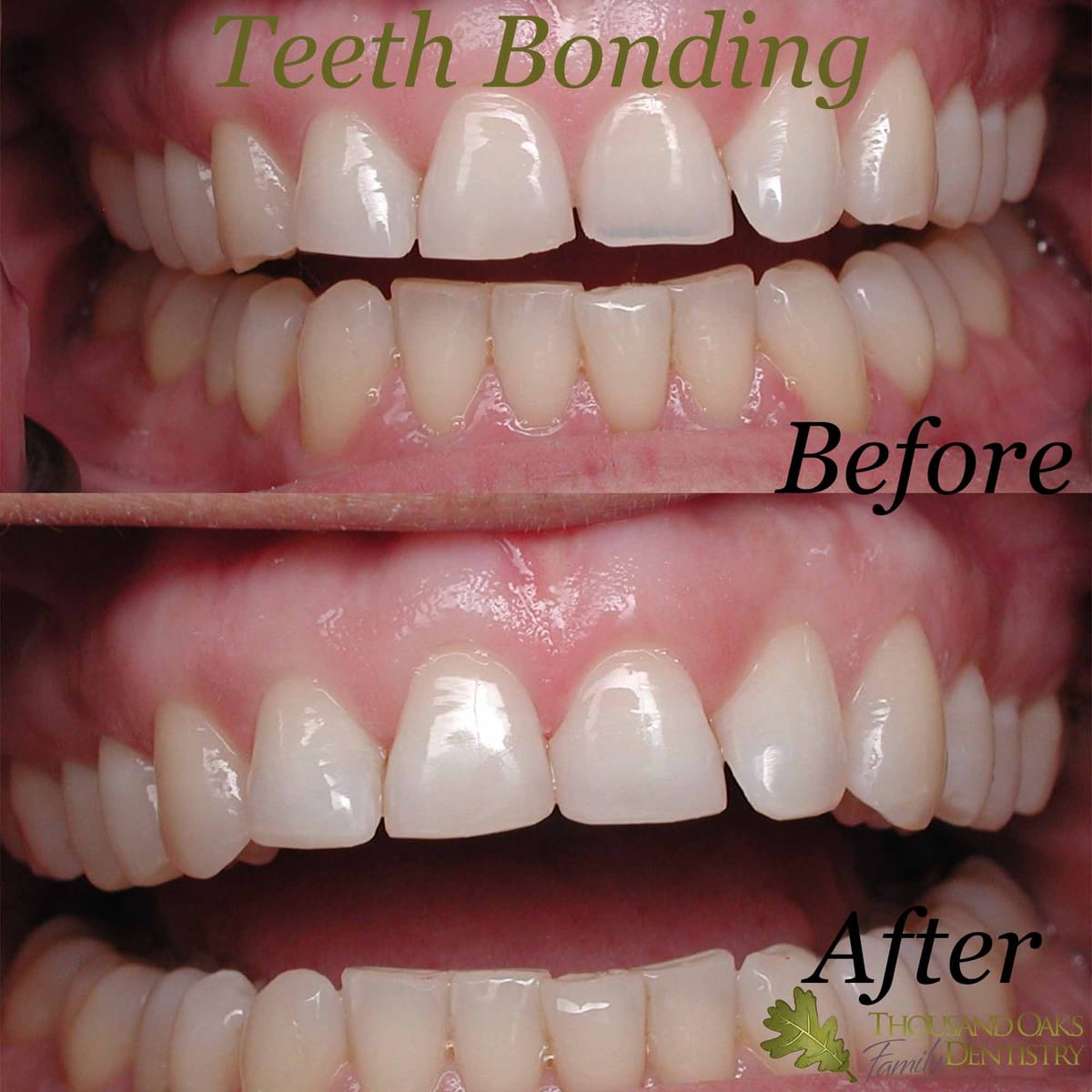 Before and after of uneven front teeth evened out with cosmetic bonding