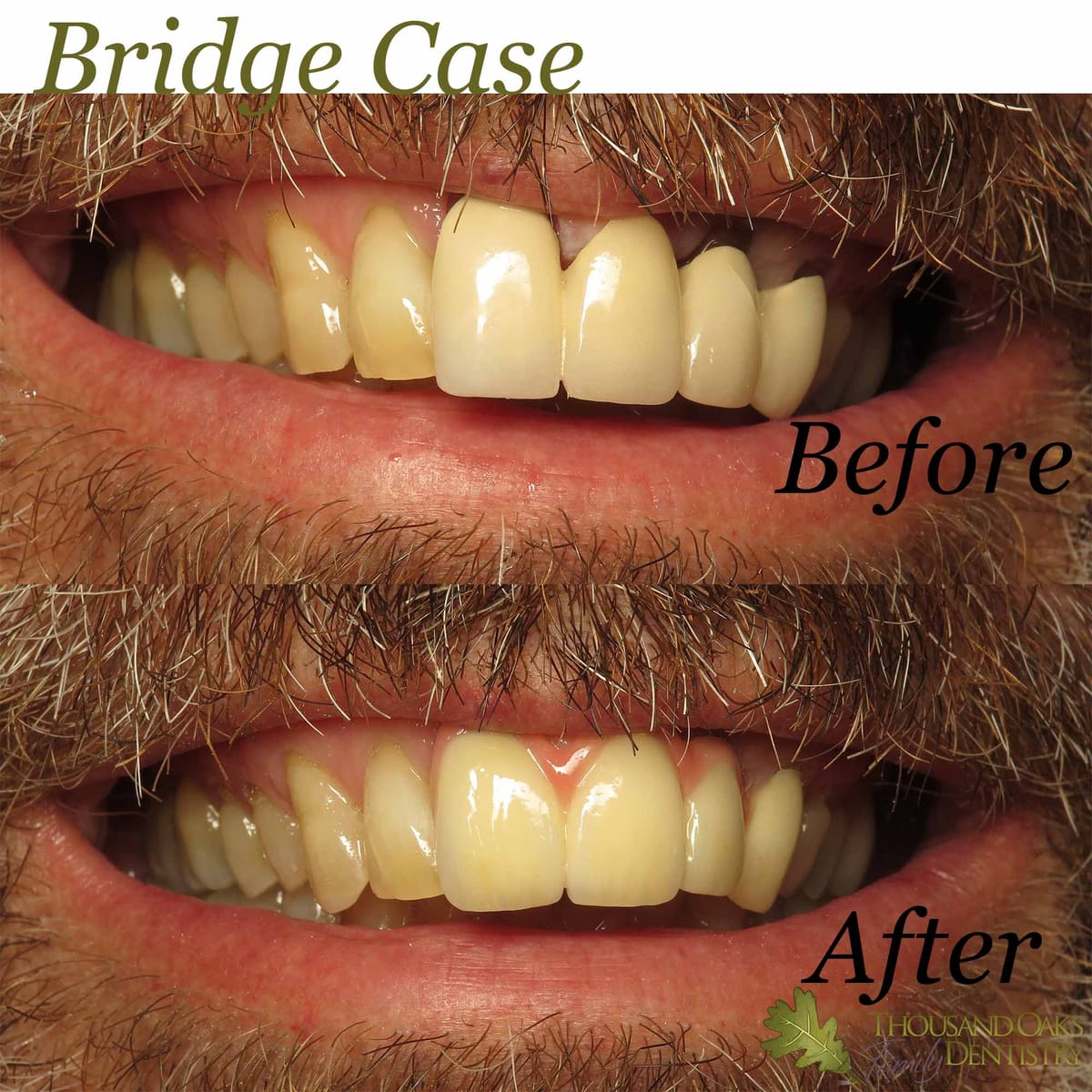 Before and after of missing and worn front teeth restored with a natural-looking dental bridge
