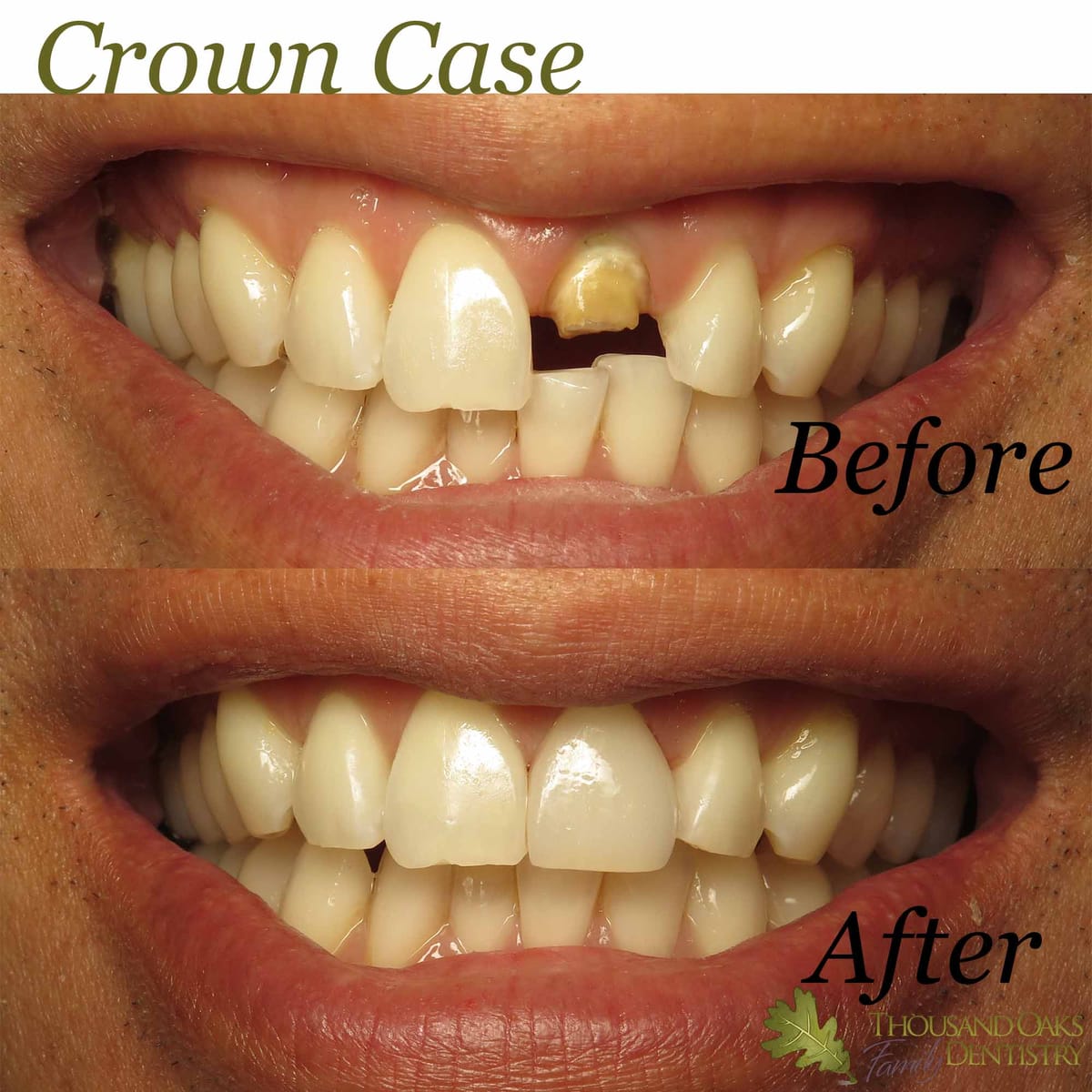 Before and after of a discolored, broken front tooth restored with a natural-looking crown