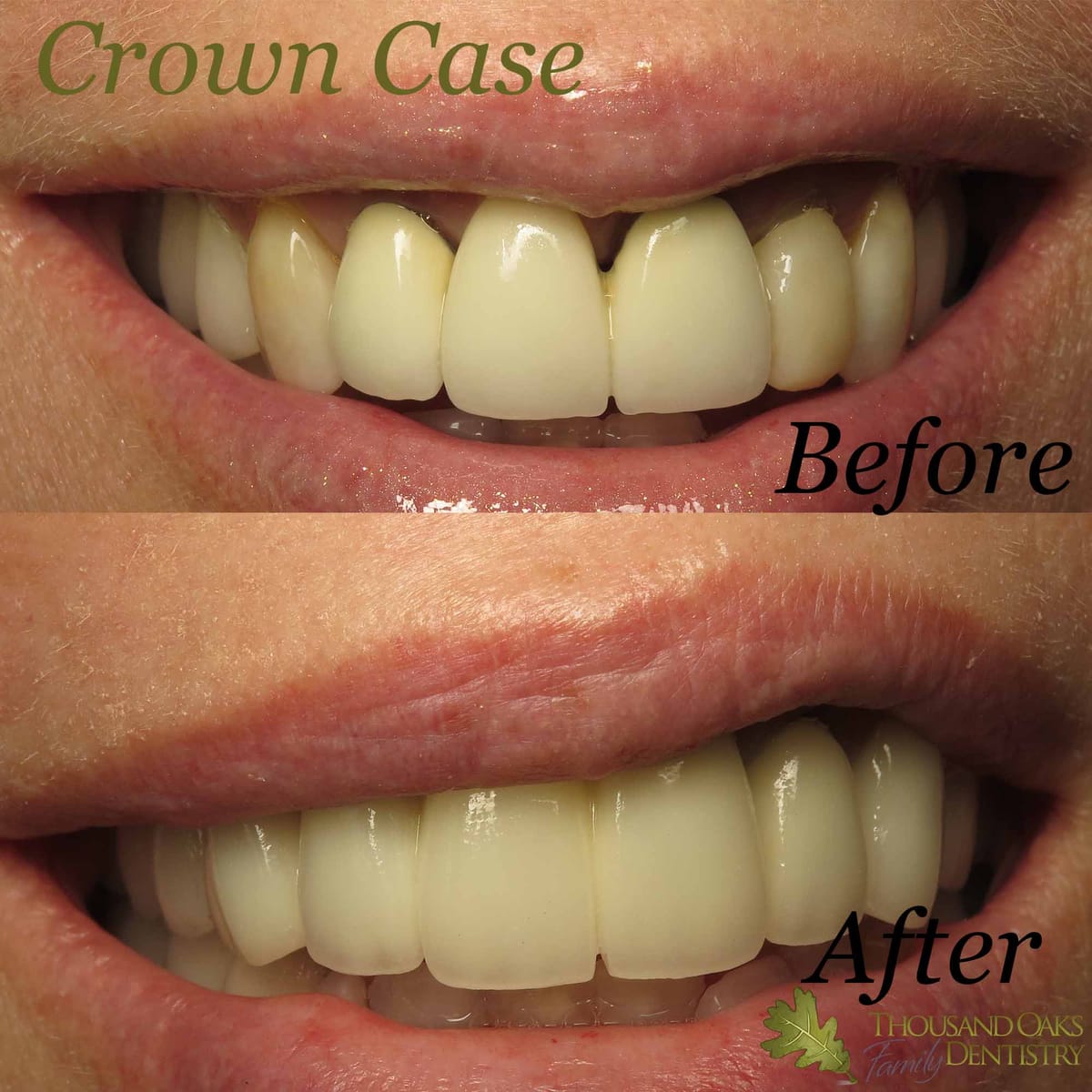 Before and after of worn upper teeth restored with ceramic crowns for a fuller, brighter smile