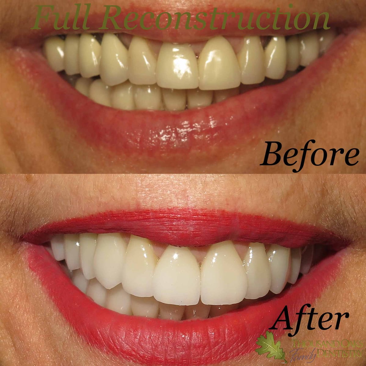 Before and after of a full smile reconstruction showing worn, uneven teeth restored to a bright, even smile