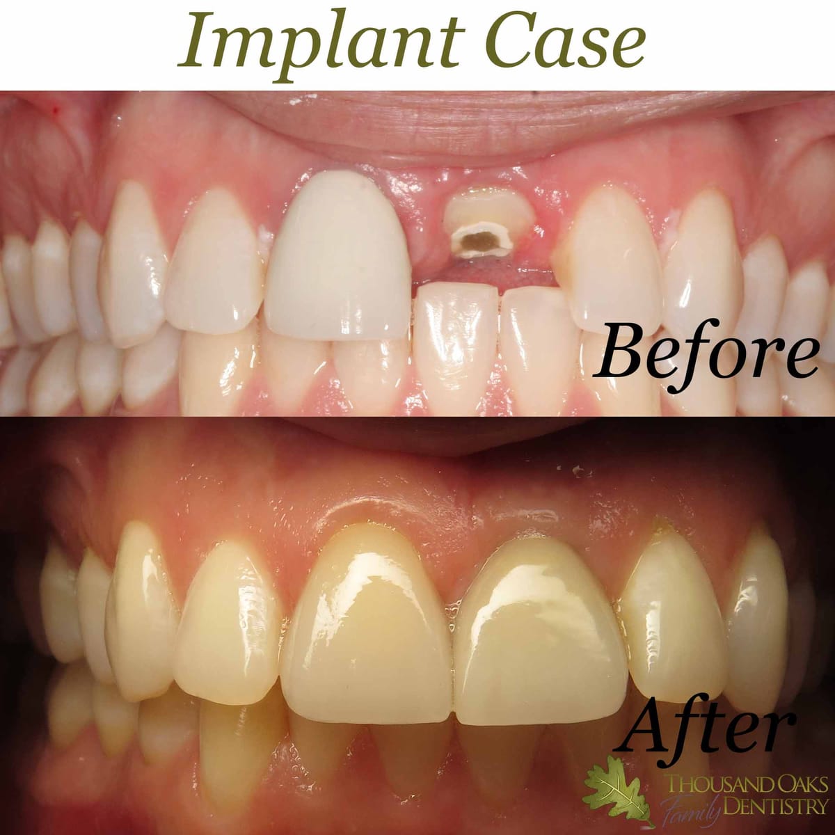 Before and after of a failing front tooth replaced with an implant crown that blends with the natural teeth